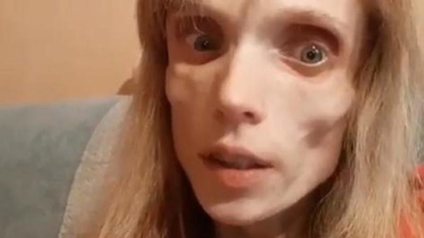 "You could play a corpse in a horror movie": doctor humiliated girl with anorexia