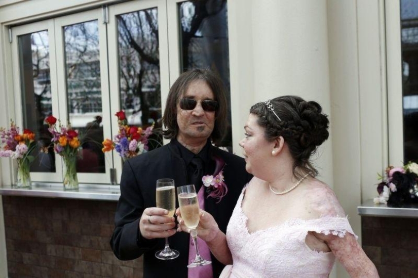 'Man without a face' marries after transplant