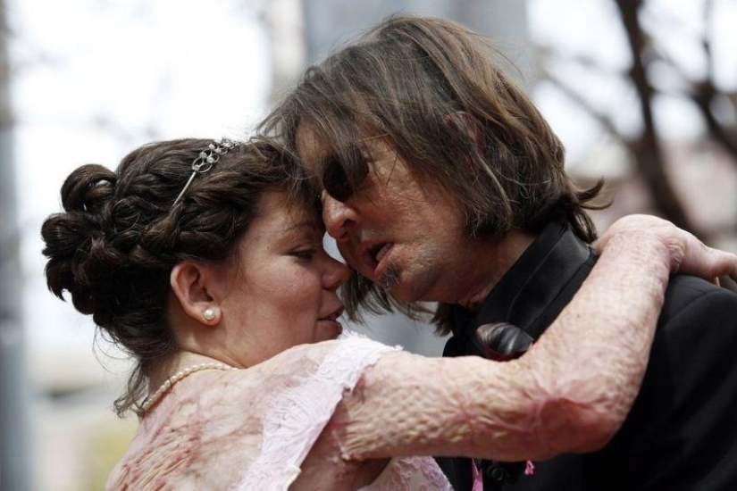 'Man without a face' marries after transplant