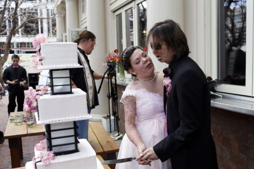 'Man without a face' marries after transplant