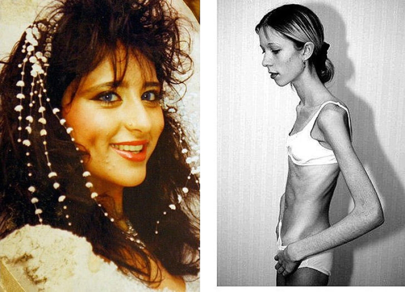 8 famosos que murieron de anorexia