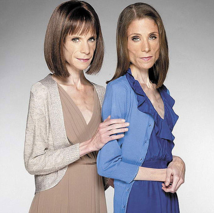 8 famosos que murieron de anorexia