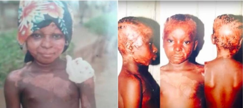 A girl with severe facial burns demonstrates the power of makeup