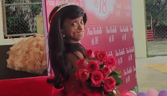 A girl with the body of a 150-year-old woman died in the Philippines