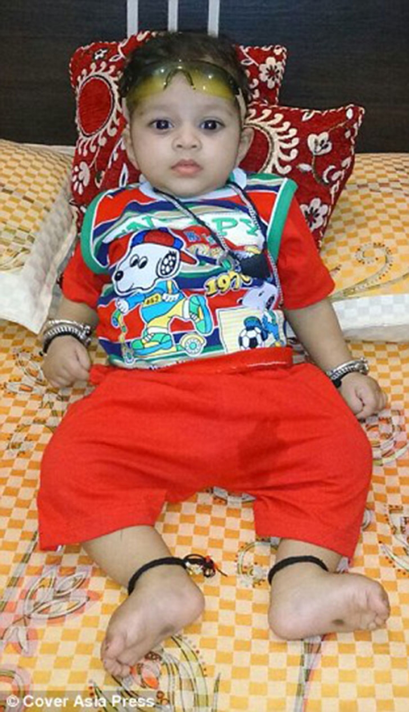 A two-year-old baby from India suffers from premature puberty A two-year-old baby from India suffers from premature puberty