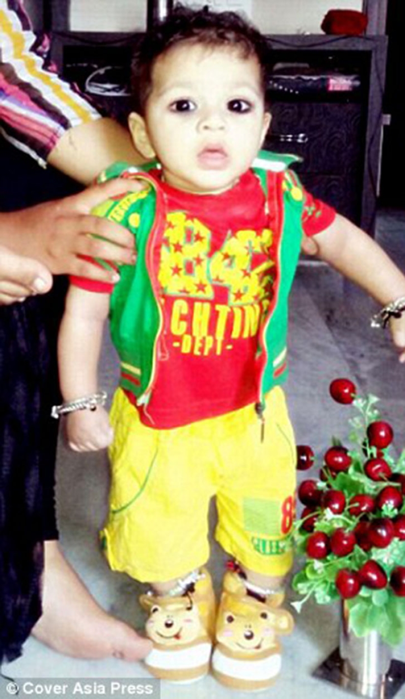 A two-year-old baby from India suffers from premature puberty A two-year-old baby from India suffers from premature puberty