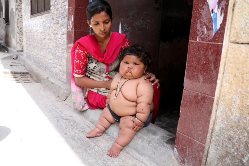 An 8-month-old girl weighs 17 kilograms, and doctors cannot diagnose her An 8-month-old girl weighs 17 kilograms, and doctors cannot diagnose her