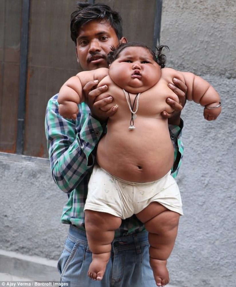 An 8-month-old girl weighs 17 kilograms, and doctors cannot diagnose her An 8-month-old girl weighs 17 kilograms, and doctors cannot diagnose her