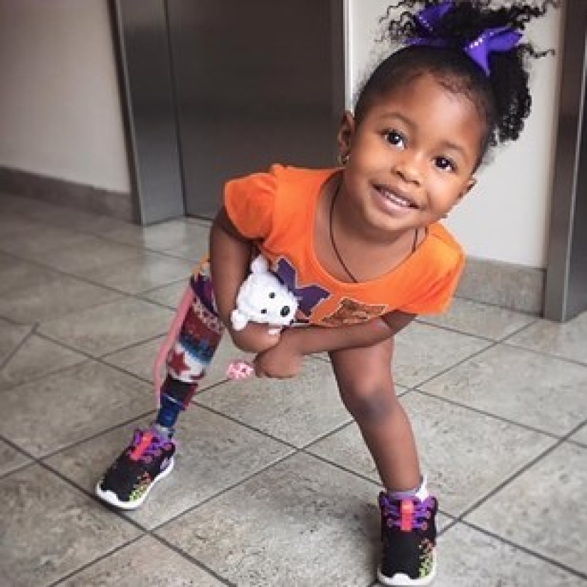 Aurora Cairo es una encantadora bebé de 2 años con una pierna protésica