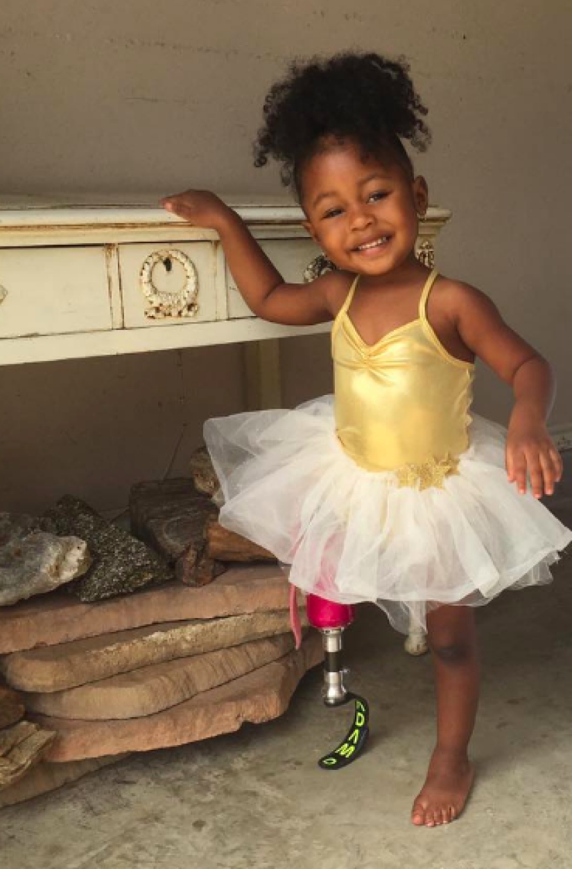 Aurora Cairo is a charming 2—year-old baby with a prosthetic leg Aurora Cairo is a charming 2—year-old baby with a prosthetic leg