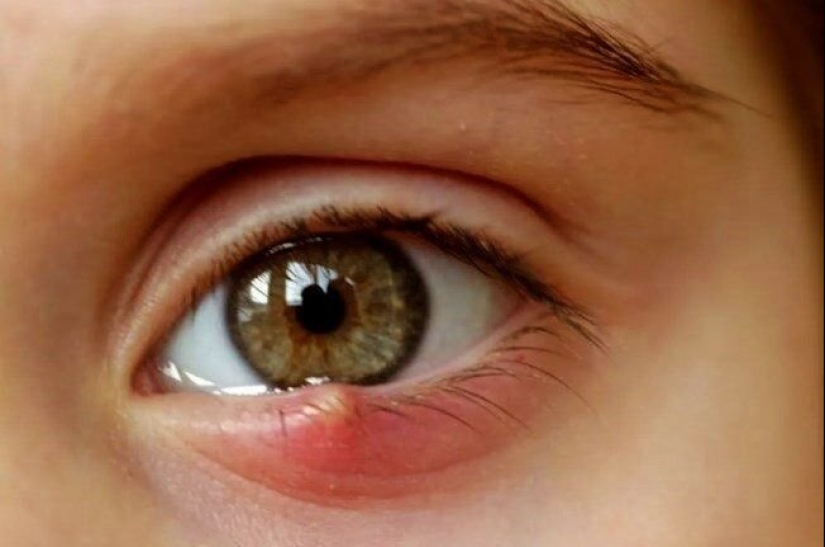 Barley on the eye, what kind of disease is this. What causes barley