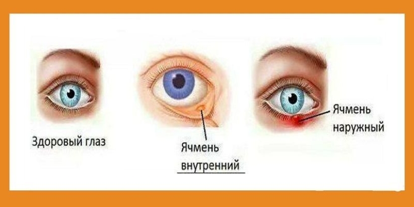 Barley on the eye, what kind of disease is this. What causes barley