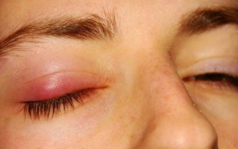 Barley on the eye, what kind of disease is this. What causes barley