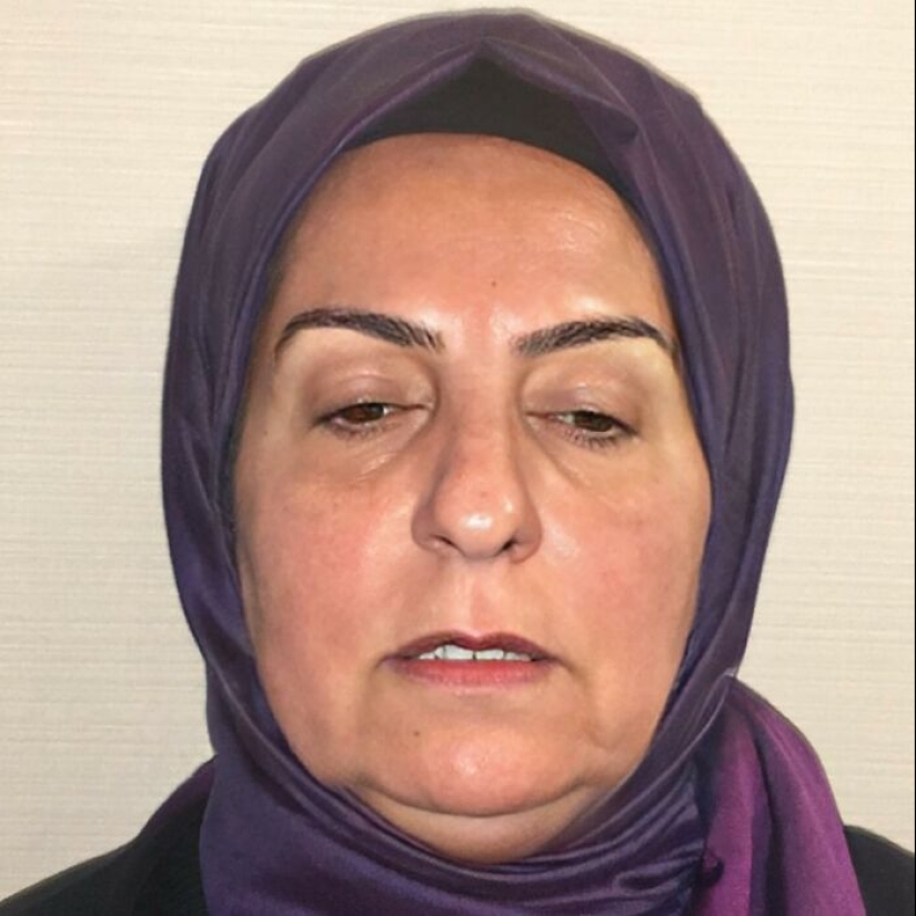 Before And After Photos From Turkish Plastic Surgery Clinic Have Left People Baffled