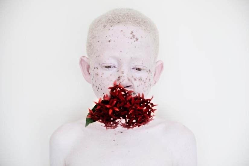 Blancura mortal: Retratos increíbles de los albinos de Tanzania
