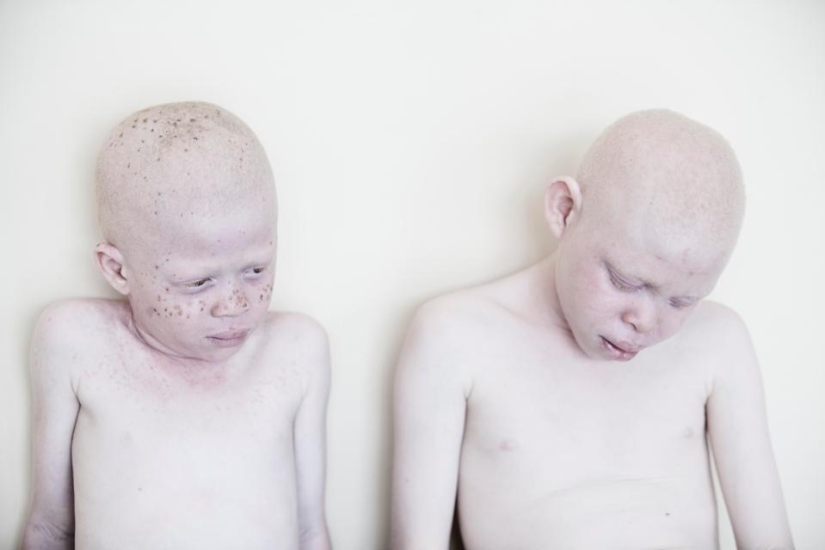 Blancura mortal: Retratos increíbles de los albinos de Tanzania