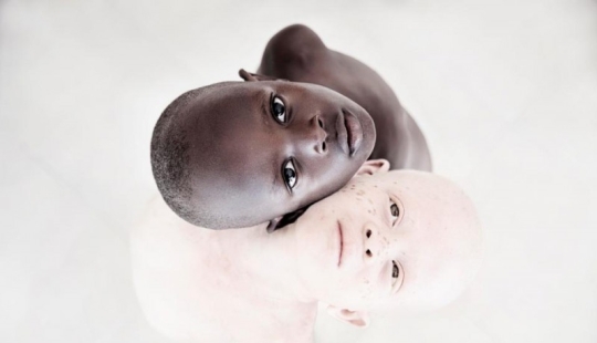 Blancura mortal: Retratos increíbles de los albinos de Tanzania