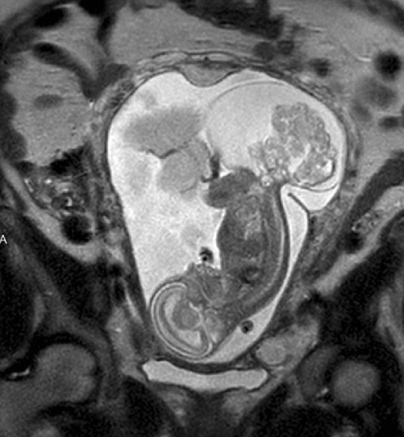 Born twice: doctors took the baby out of the womb to operate and bring it back