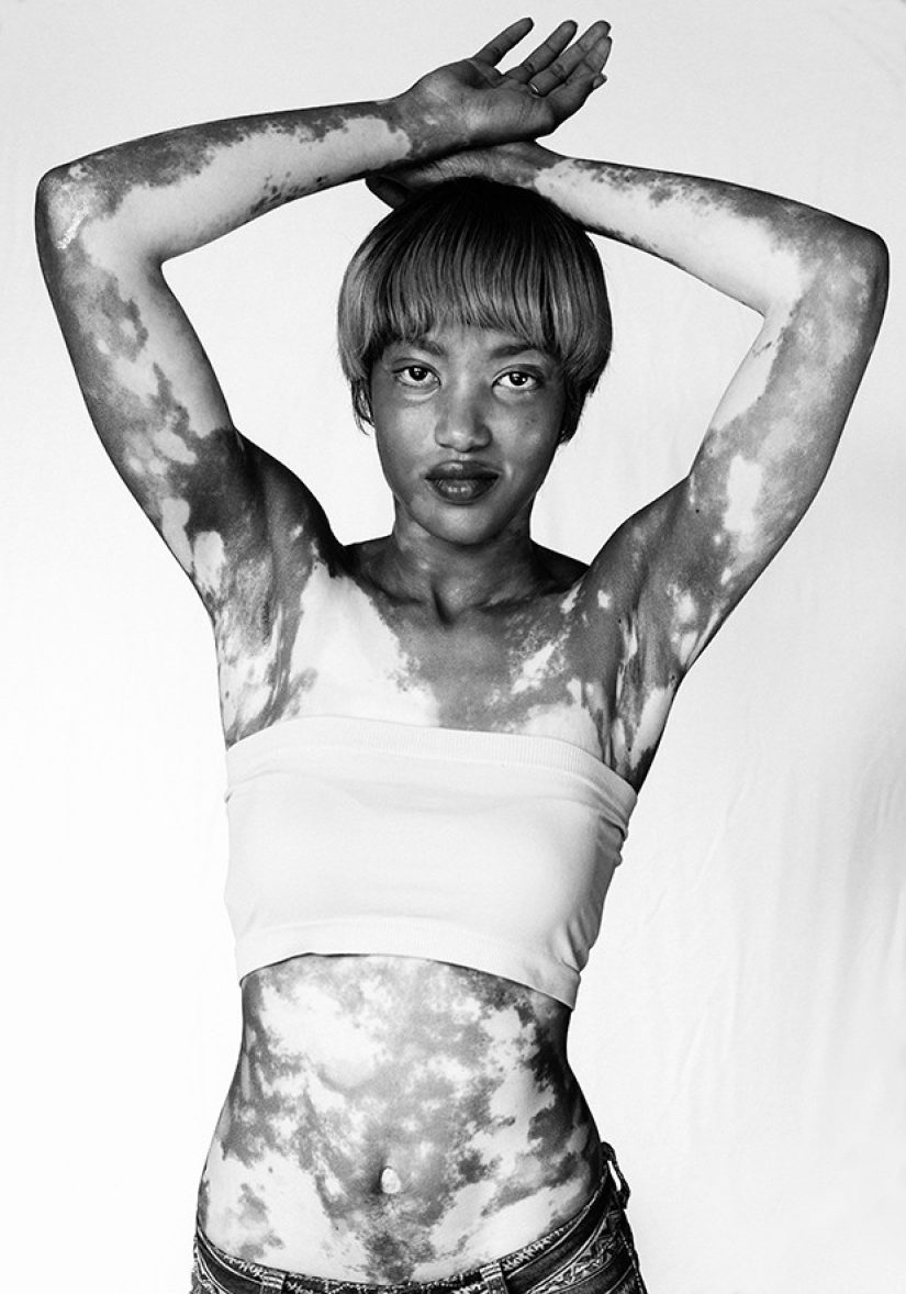 Discover the beauty of vitiligo Discover the beauty of vitiligo