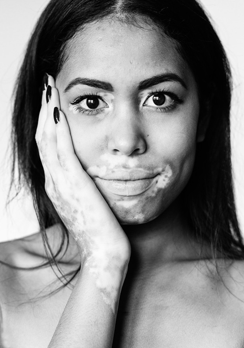 Discover the beauty of vitiligo Discover the beauty of vitiligo