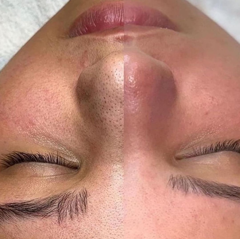 Do not confuse black dots with sebaceous threads! What is their difference and how to get rid of them