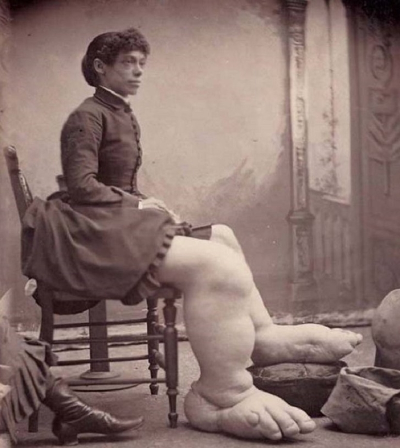 Es difícil de creer, ¡pero estas 5 personas con anomalías realmente existieron! Es difícil de creer, ¡pero estas 5 personas con anomalías realmente existieron!