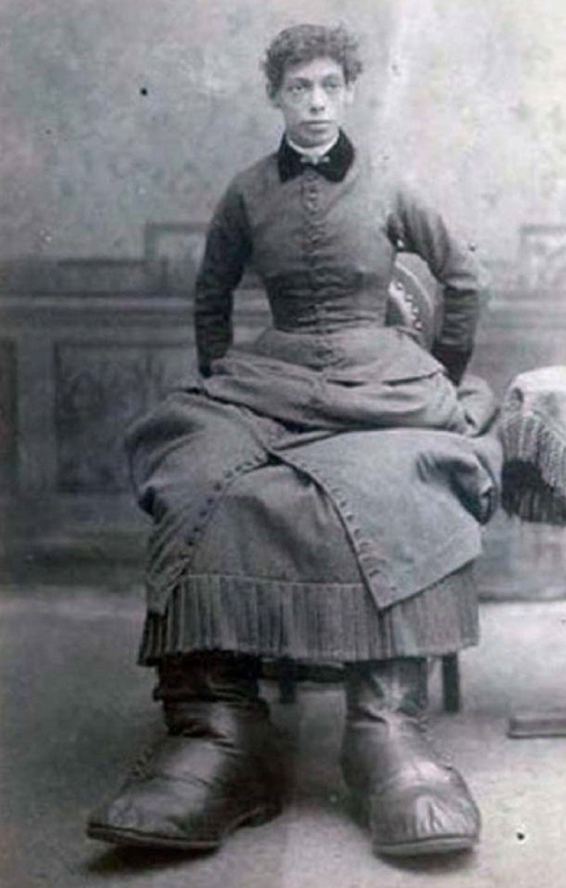 Es difícil de creer, ¡pero estas 5 personas con anomalías realmente existieron! Es difícil de creer, ¡pero estas 5 personas con anomalías realmente existieron!