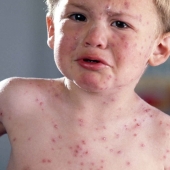 Everything you need to know about the Coxsackie virus