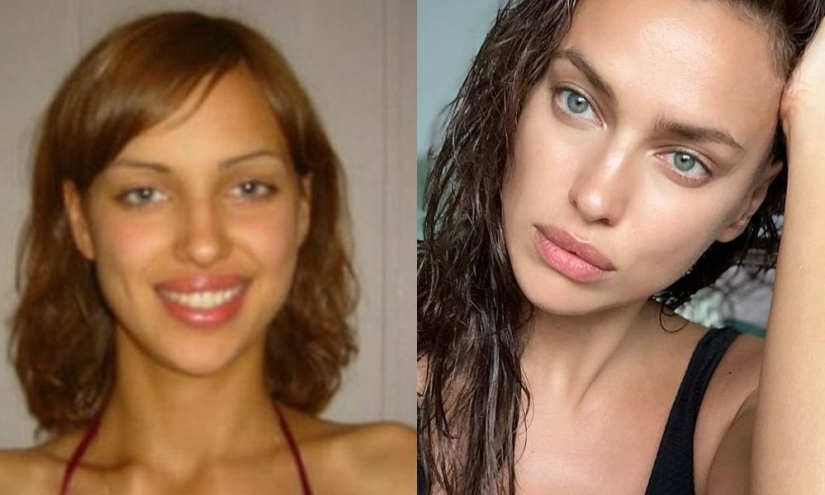Getting plastic surgery was the best decision: 10 miraculous transformations of stars