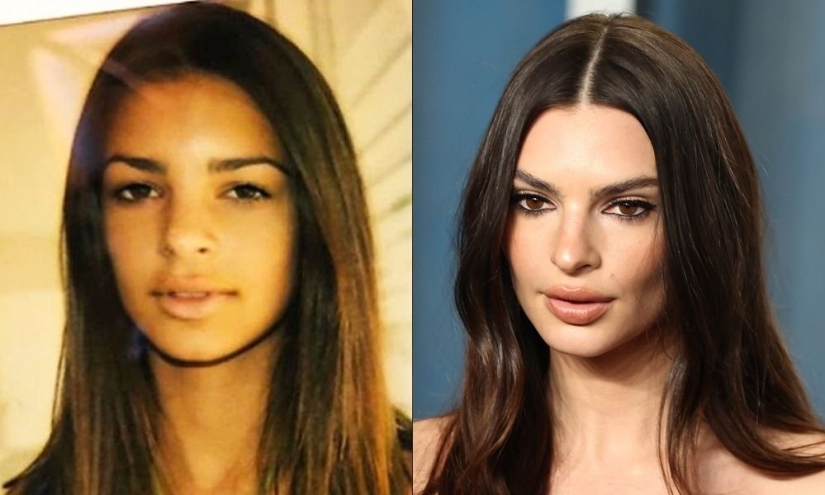 Getting plastic surgery was the best decision: 10 miraculous transformations of stars