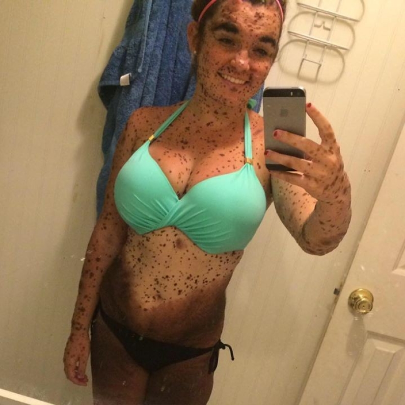 Girl with rare skin condition takes pride in being different Girl with rare skin condition takes pride in being different