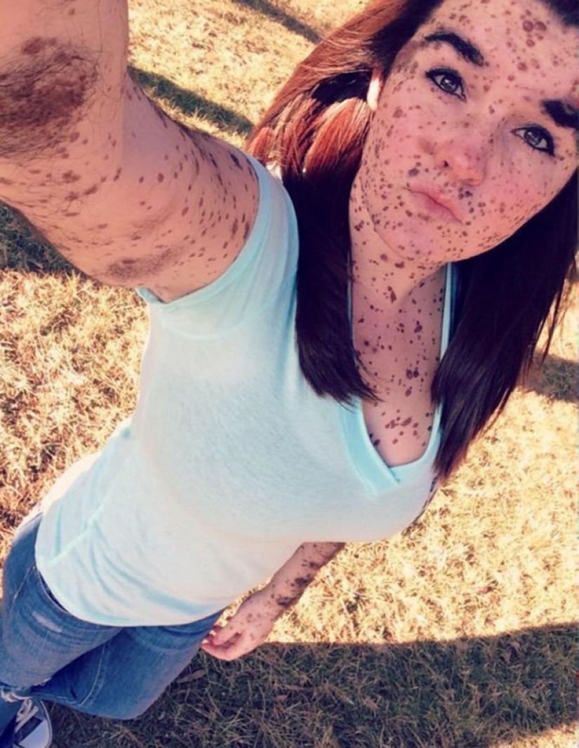 Girl with rare skin condition takes pride in being different Girl with rare skin condition takes pride in being different