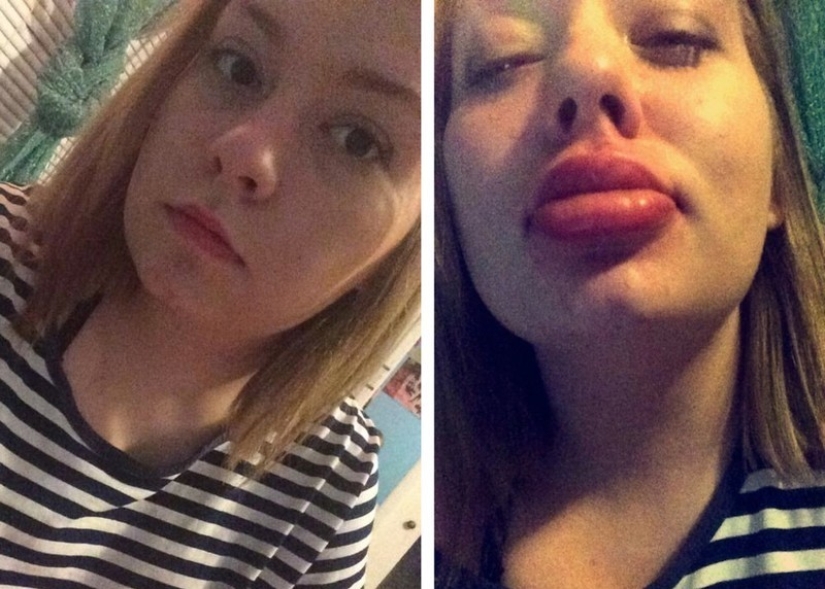 Girls try to make their lips plump like a TV star. It doesn't turn out very...