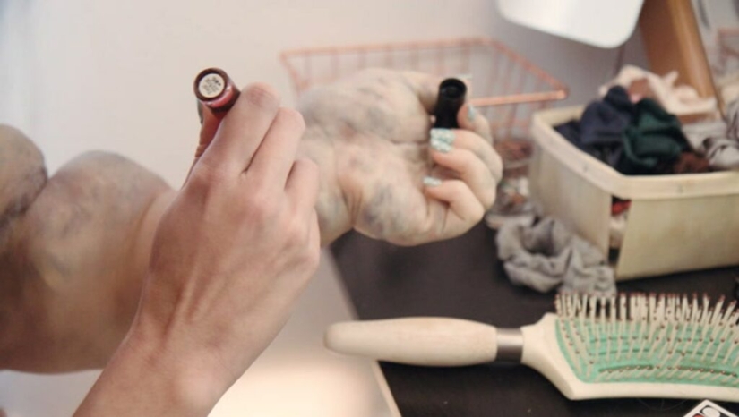 How Olivia Klopchin lives — a girl with a monster hand