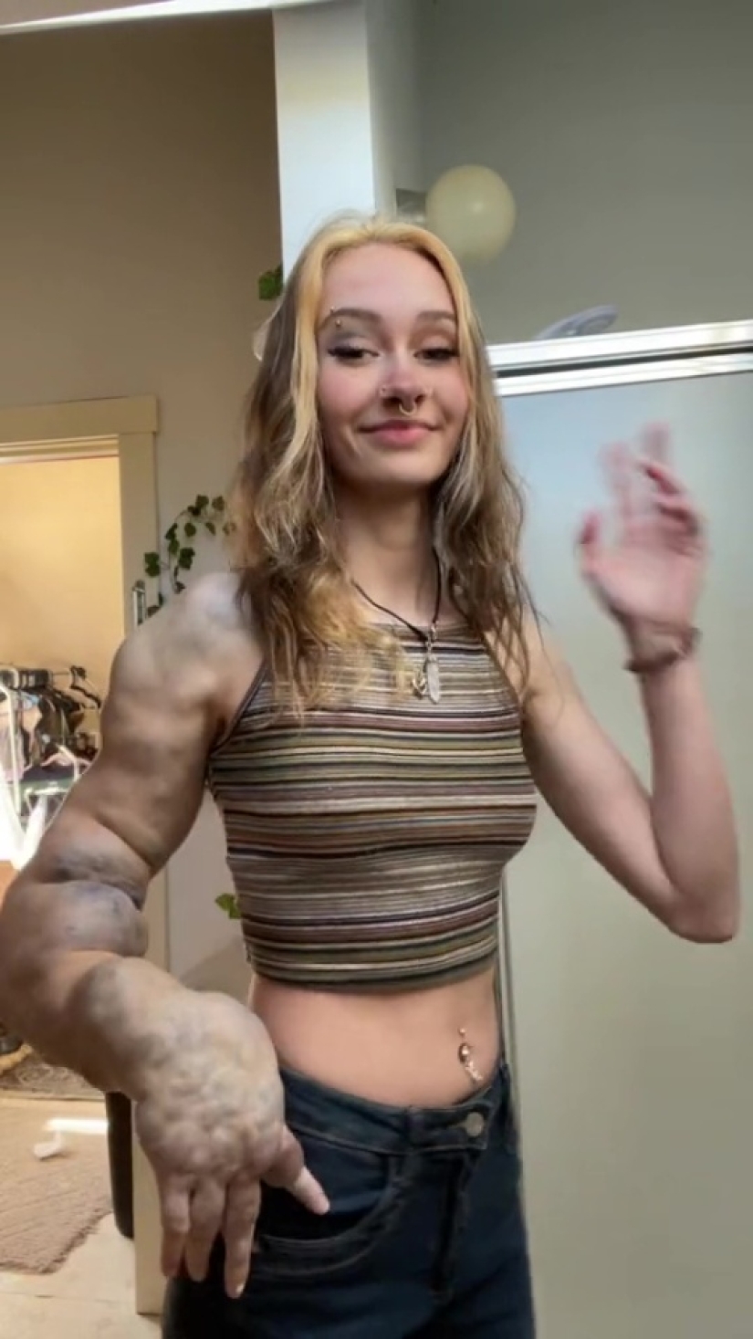 How Olivia Klopchin lives — a girl with a monster hand