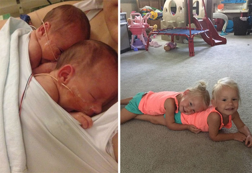 Inseparable twins holding each other's hand at birth, two years later
