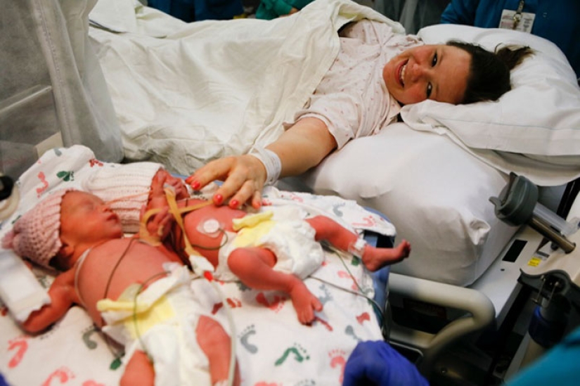 Inseparable twins holding each other's hand at birth, two years later