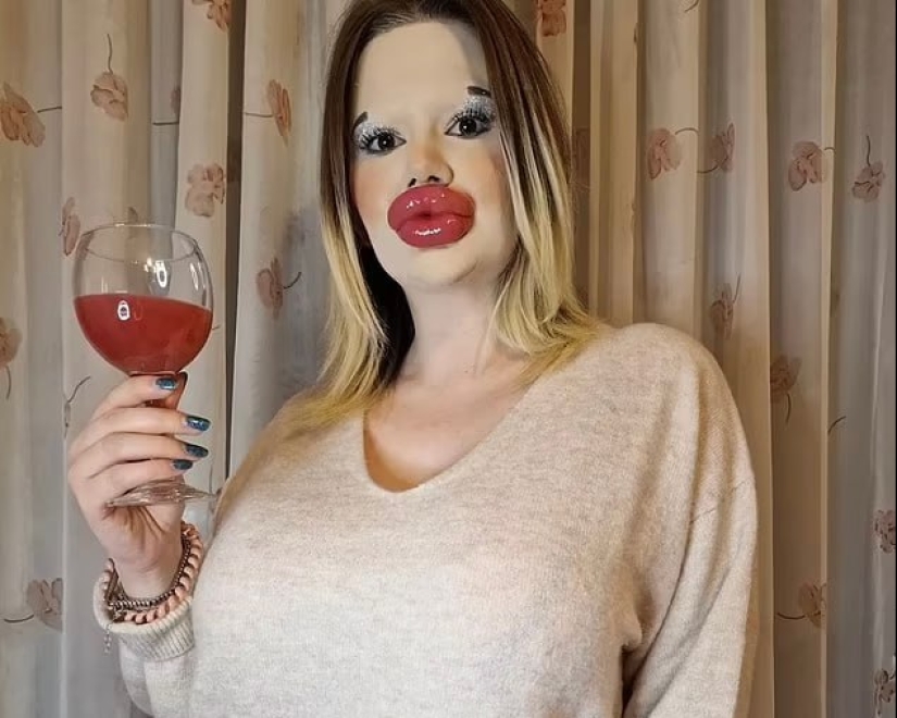 La chica con los labios más grandes del mundo decidió agrandar sus pómulos