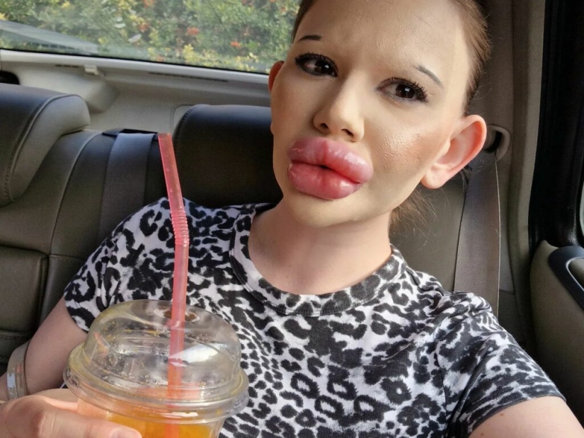 La chica con los labios más grandes del mundo decidió agrandar sus pómulos