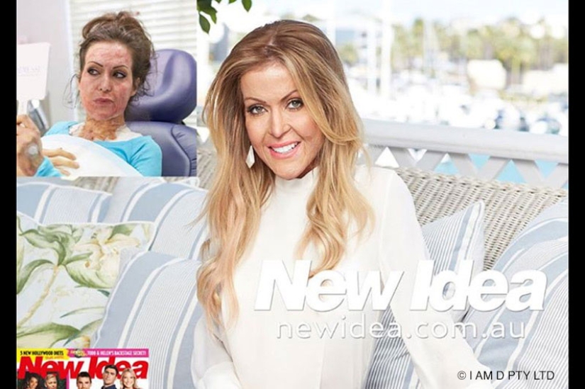 La mujer australiana que alguna vez estuvo a punto de quemarse viva finalmente se quitó la máscara La mujer australiana que alguna vez estuvo a punto de quemarse viva finalmente se quitó la máscara