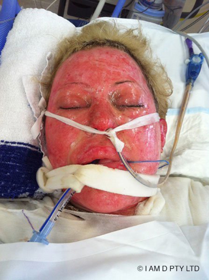 La mujer australiana que alguna vez estuvo a punto de quemarse viva finalmente se quitó la máscara La mujer australiana que alguna vez estuvo a punto de quemarse viva finalmente se quitó la máscara