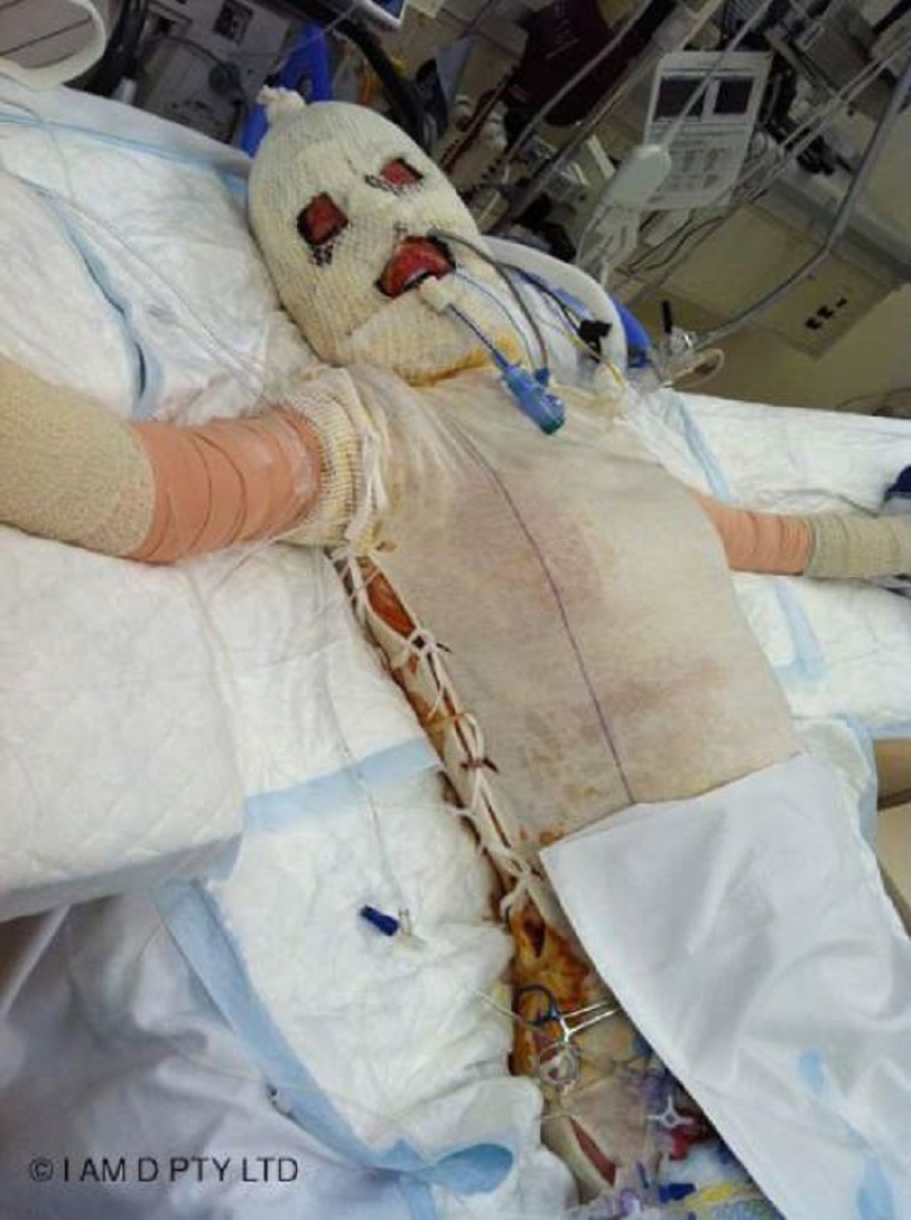 La mujer australiana que alguna vez estuvo a punto de quemarse viva finalmente se quitó la máscara La mujer australiana que alguna vez estuvo a punto de quemarse viva finalmente se quitó la máscara