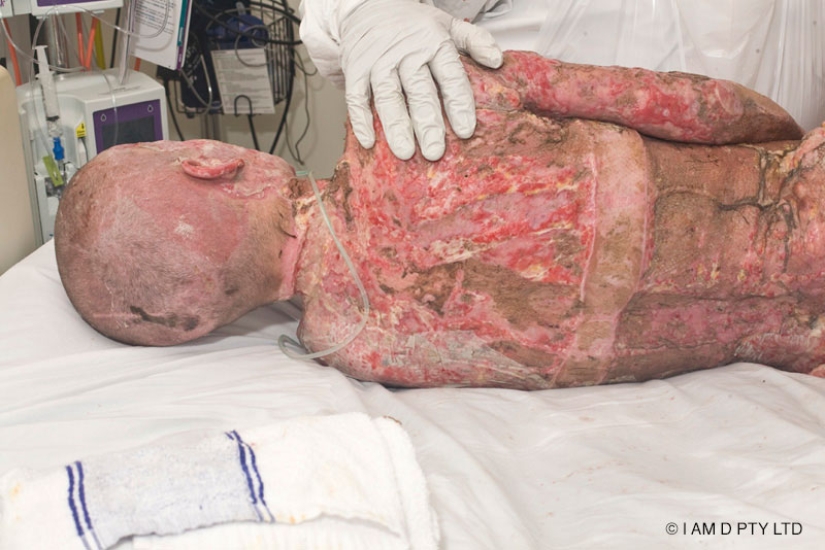 La mujer australiana que alguna vez estuvo a punto de quemarse viva finalmente se quitó la máscara La mujer australiana que alguna vez estuvo a punto de quemarse viva finalmente se quitó la máscara