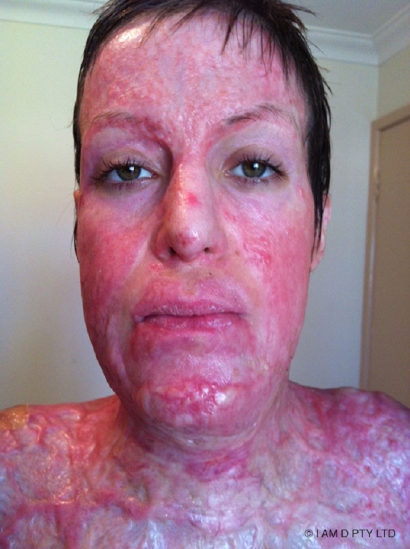 La mujer australiana que alguna vez estuvo a punto de quemarse viva finalmente se quitó la máscara La mujer australiana que alguna vez estuvo a punto de quemarse viva finalmente se quitó la máscara