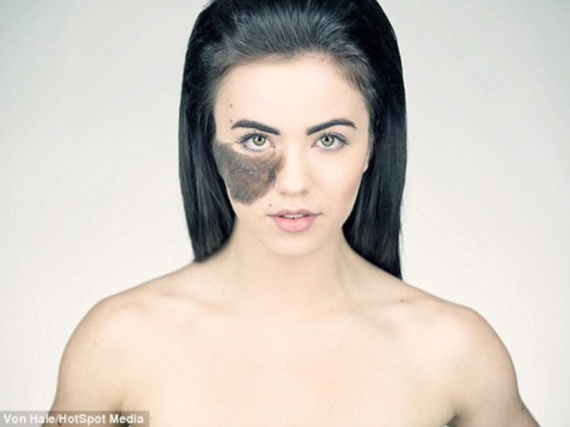 La niña se niega a quitarse la marca de nacimiento, considerándola su punto culminante. La niña se niega a quitarse la marca de nacimiento, considerándola su punto culminante.