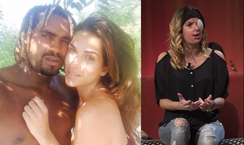 La reina de belleza, que fue rociada con ácido por su ex prometido, mostró un rostro desfigurado