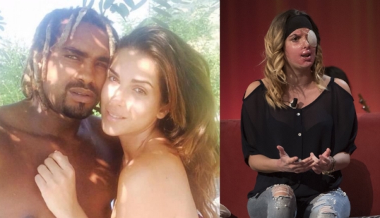 La reina de belleza, que fue rociada con ácido por su ex prometido, mostró un rostro desfigurado La reina de belleza, que fue rociada con ácido por su ex prometido, mostró un rostro desfigurado