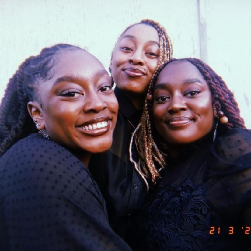 Los gemelos siameses separados en la infancia continúan durmiendo de la misma manera que antes de la operación