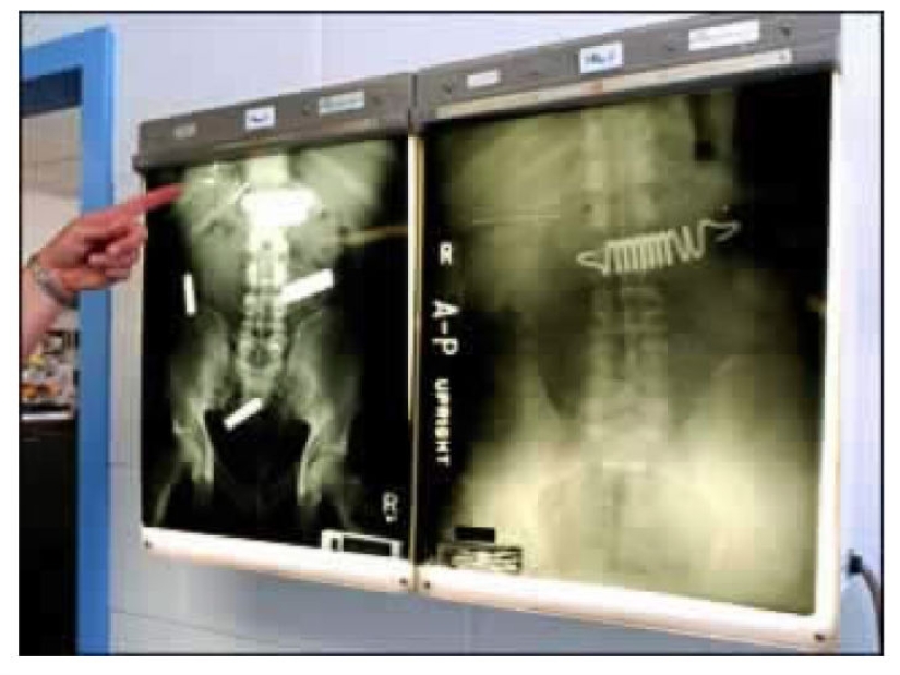 Los objetos más espeluznantes que se han encontrado en un estómago humano Los objetos más espeluznantes que se han encontrado en un estómago humano