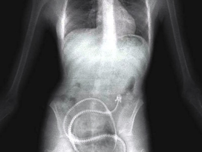 Los objetos más espeluznantes que se han encontrado en un estómago humano Los objetos más espeluznantes que se han encontrado en un estómago humano